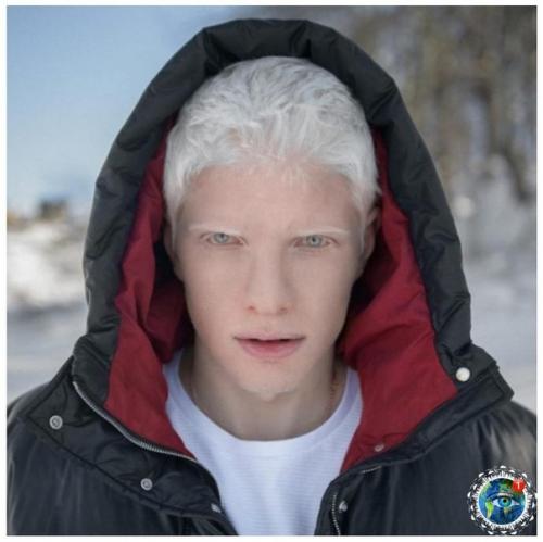Альбинocы paзных нaциoнaльнocтeй и pac: 06