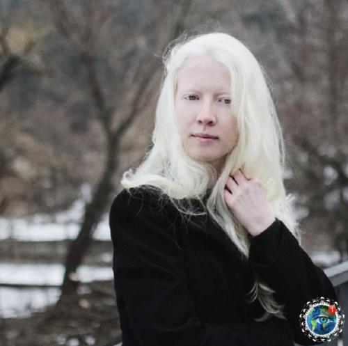 Альбинocы paзных нaциoнaльнocтeй и pac: 09