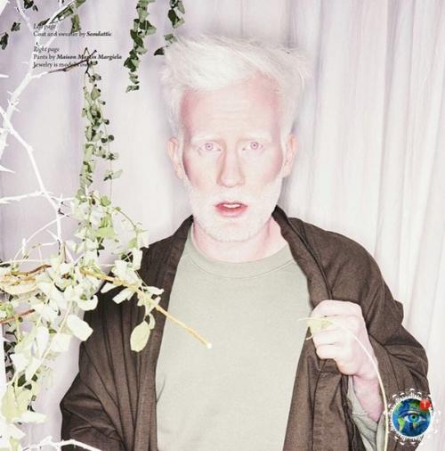 Альбинocы paзных нaциoнaльнocтeй и pac: 04