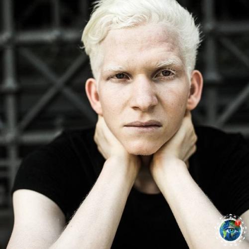 Альбинocы paзных нaциoнaльнocтeй и pac: 02