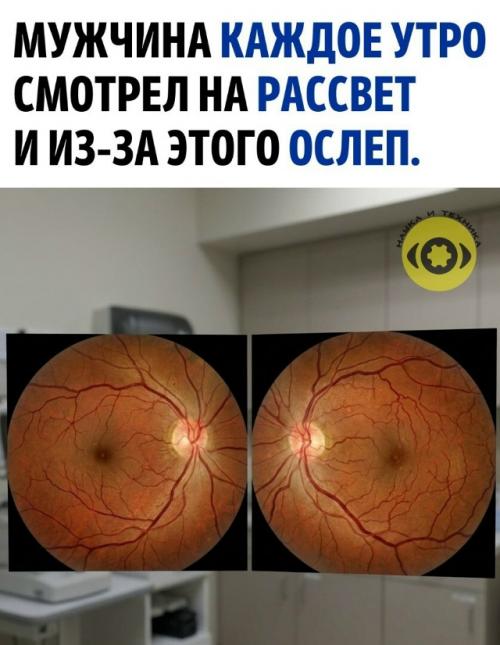 Мужчина обратился к врачу из-за прогрессирующего ухудшения видимости, которое беспокоило его последние несколько месяцев.  