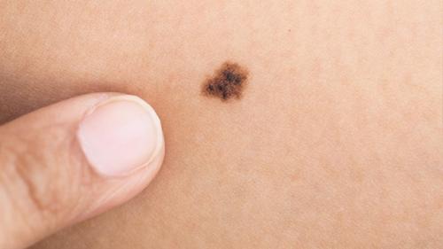 Американские учёные создали пластырь с микроиглами, позволяющий определять меланому - наиболее опасную форму рака кожи - прямо у себя дома. 01