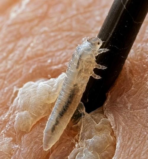 Демодекс размером около 0, 3 мм живёт в сальных железах, питается кожным салом и активнее размножается ночью. 01