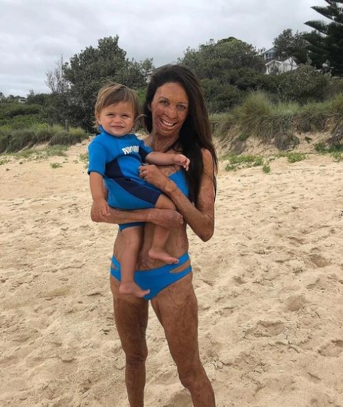 Эта 33-летняя австралийская модель попала в беду - из-за пожара у нее обгорело 70% тела. 04