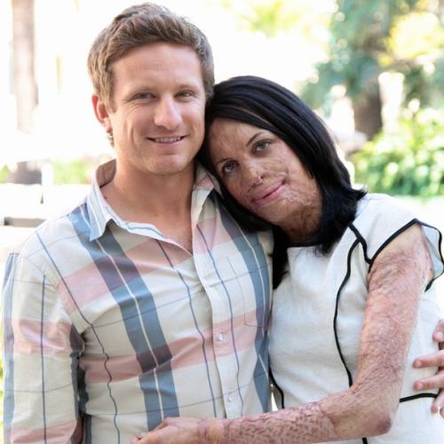 Эта 33-летняя австралийская модель попала в беду - из-за пожара у нее обгорело 70% тела. 03