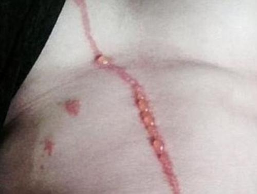 Паук туннель под кожей парня прорыл. 03