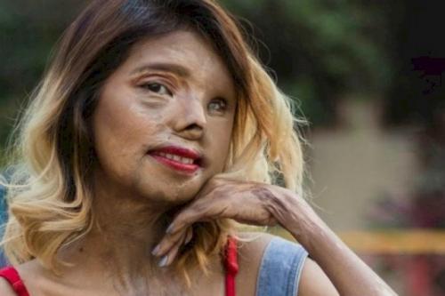 23-Летняя девушка, которую отец облил кислотой, в данный момент стремится стать моделью. 02