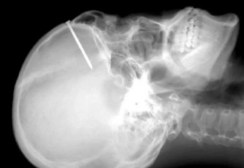 В больницу обратился мужчина 44 лет с жалобами на то, что в течение трёх месяцев он наносил себе травмы, вбивая гвозди в череп. 02