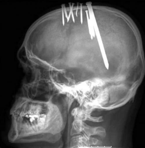 В больницу обратился мужчина 44 лет с жалобами на то, что в течение трёх месяцев он наносил себе травмы, вбивая гвозди в череп. 01