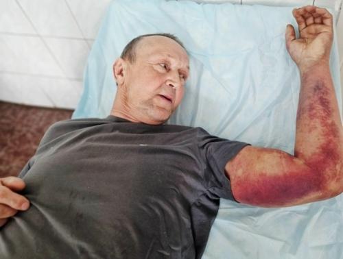 Житель Татарстана попал в реанимацию после попытки собрать крапиву для супа - всё закончилось укусом змеи, отёком квинке и клещом. 02