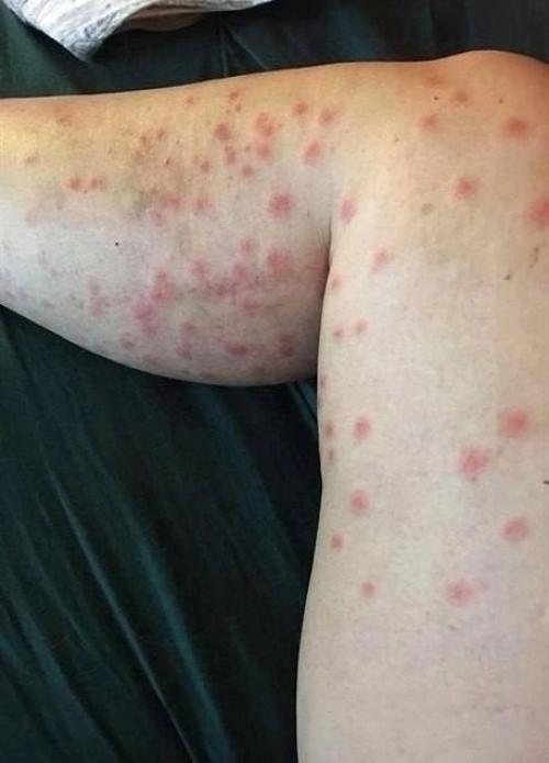 Церкарии атакуют российских туристов! 

