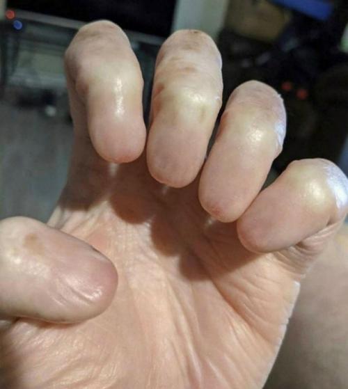 Анохиния.  Так называется врождённое или приобретённое отсутствие ногтевых пластин.