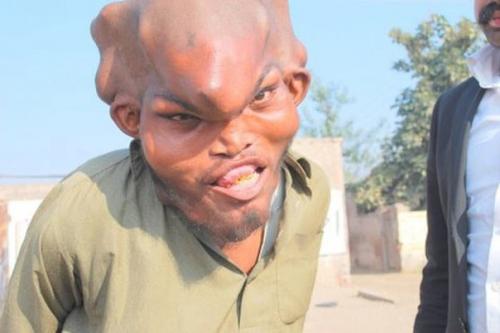 Синдром протея.  Синдром протея вызывает быстрый и непропорциональный рост костей и кожных покровов, вызванный мутацией в гене Akt1.