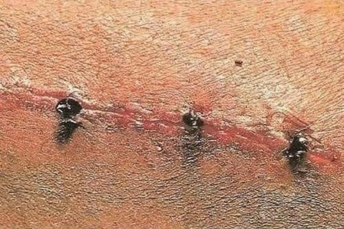 Лишь в том случае, если рядом нет хирурга - зашей рану … муравьем. 02