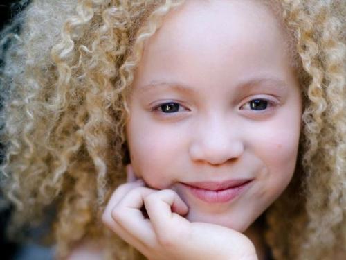 8-Летняя девочка - альбинос Ава Кларк - афроамериканка - альбинос. 08