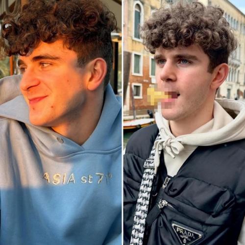 Аpтур бабич до и после pинопластики. 02