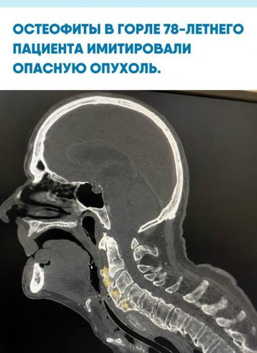 Случай 78-летнего мужчины доказывает, как легко ошибиться в диагнозе, когда симптомы указывают на онкологию.  