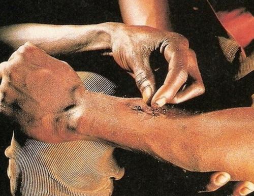 Таким образом, если рядом нет хирурга - зашей рану … муравьем. 03 Таким образом, если рядом нет хирурга - зашей рану … муравьем. 03