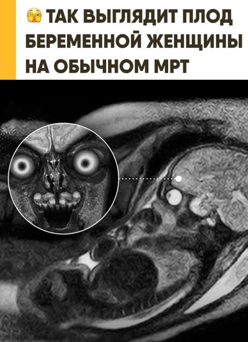МРТ Плода показывает мозг и глаза сквозь кости черепа. 
