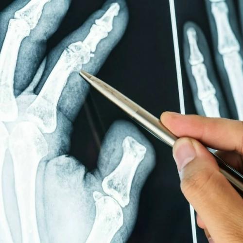 Китайские ученые создали гель, заживляющий переломы за 3 минуты.