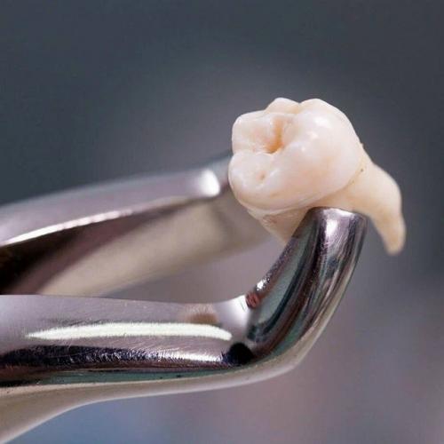 В тверской области у 34-летнего Александра удалили зуб мудрости, а через неделю мужчина скончался. 01