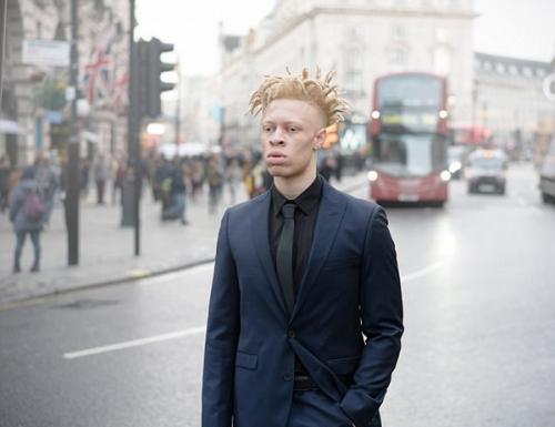 23-Летний лео джона из Лондона - альбинос.