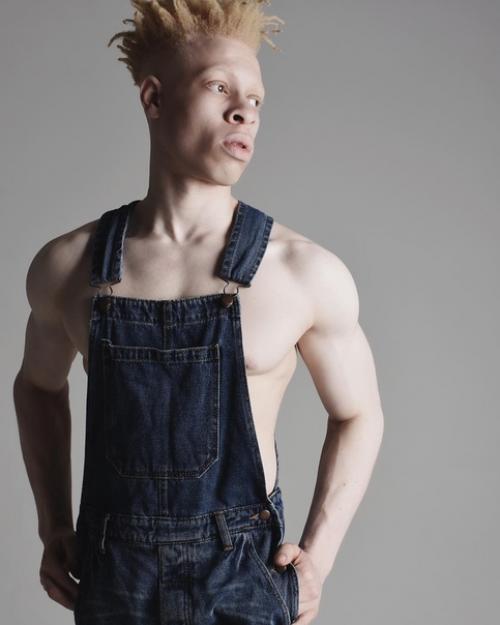 23-Летний лео джона из Лондона - альбинос. 02