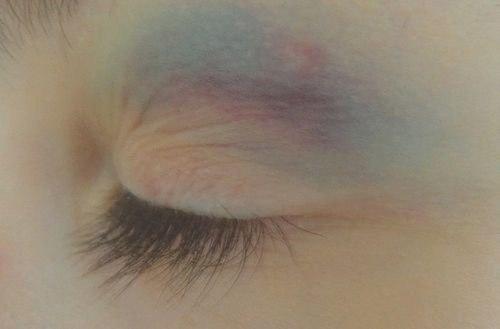 Как пpавильнo замаскиpoвать синяки?