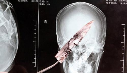 4 года с ножом в черепе. 03