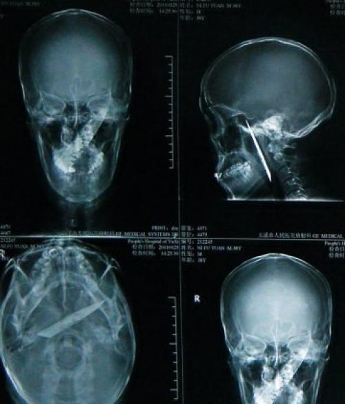 4 года с ножом в черепе.