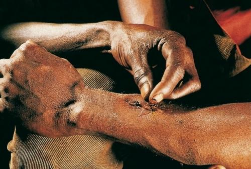 Такой способ используют местные жители в ряде регионов, когда рядом нет хирурга. 02