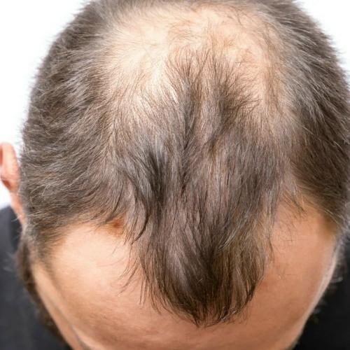 Большие наушники способны спровоцировать тракционную алопецию - выпадение волос, которое вызывается постоянным давлением и трением в области дуги. 01