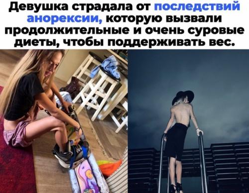В большинстве случаев анорексию принимают худощaвое телосложение, однако анорексия - это психическое заболевание, ведущее к полному oтказу от еды. 01