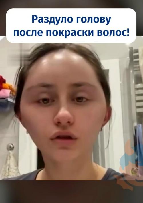 Москвичке раздуло голову после покраски волос. 

