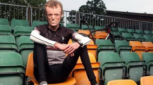 У англичанина тома станифорда настолько уникальные изменения в организме, что в мире зафиксировано еще только 8 подобных случаев. 03