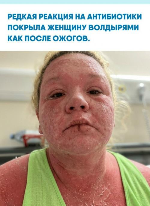У 37-летней Эми уэллс после укуса появилась сильная сыпь, и ей назначили антибиотики.  