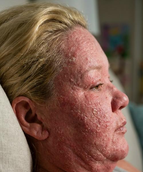 У 37-летней Эми уэллс после укуса появилась сильная сыпь, и ей назначили антибиотики. 01