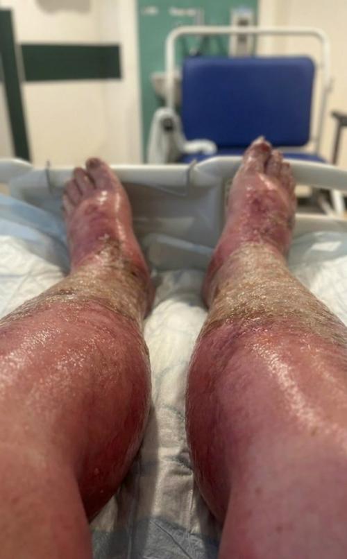 У 37-летней Эми уэллс после укуса появилась сильная сыпь, и ей назначили антибиотики. 02