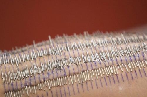 С целью установить новый рекорд Гиннеса 22-летняя стэйша Рэндалл решилась на такой шаг, как пронзить свою кожу 3200 иглами.