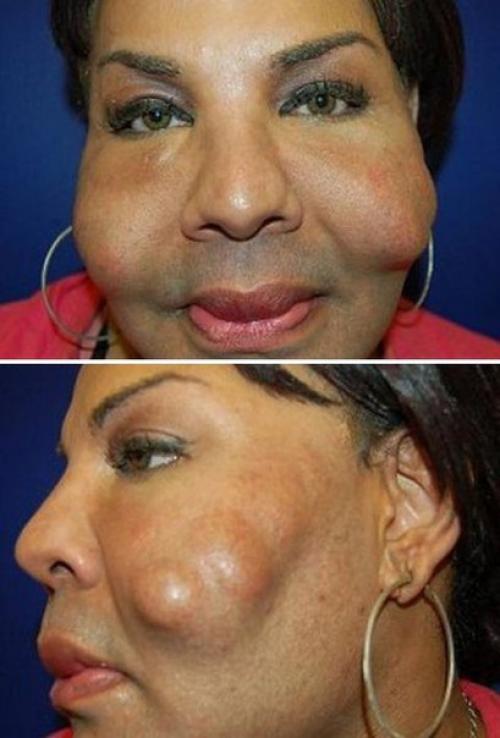 Изуродованная лжехирургом женщина - трансгендер раджи наринесинг обрела новое лицо. 04