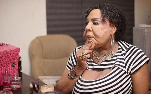 Изуродованная лжехирургом женщина - трансгендер раджи наринесинг обрела новое лицо. 03