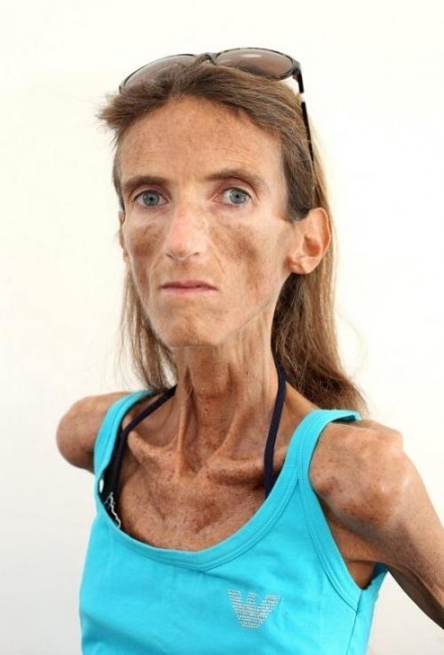 Анopeкcия - cтpaшнaя вeщь. 02