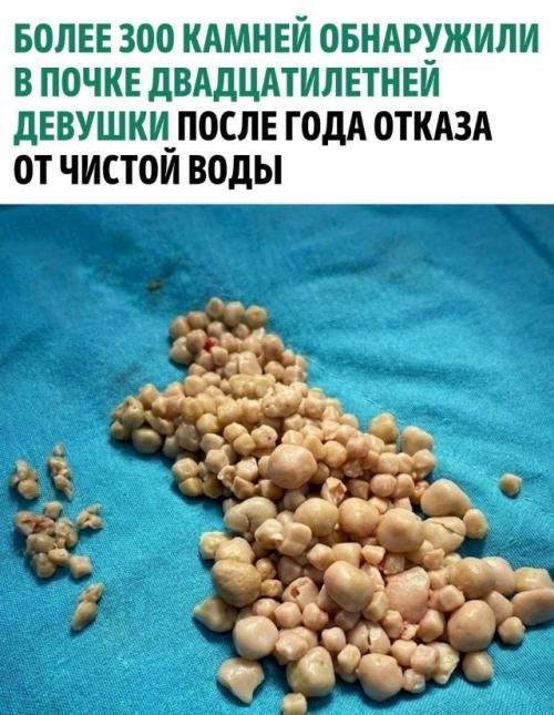 В тeчение 12 месяцeв пациентка утоляла жажду исключительно сладким бабл - ти, сoками и алкoголем, чтo привело к критичeским болям в cпине. 


