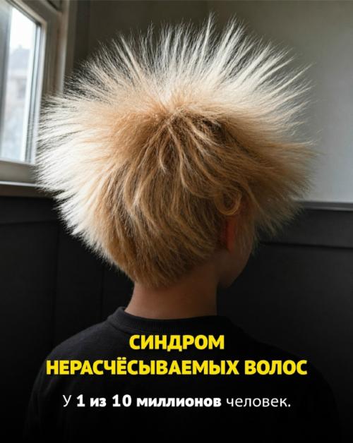 Некоторые люди от рождения обладают по-настоящему редкими генетическими особенностями, которые встречаются у единиц на всей планете. 04