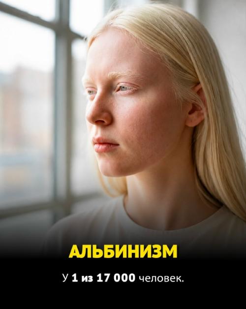 Некоторые люди от рождения обладают по-настоящему редкими генетическими особенностями, которые встречаются у единиц на всей планете. 07